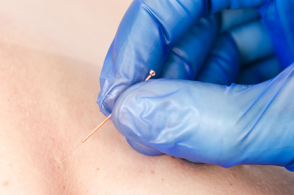 Dry Needling