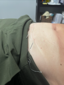 C-section Recovery involving dry needling during pelvic floor physical therapy 